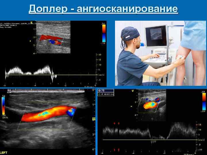 Доплер - ангиосканирование 