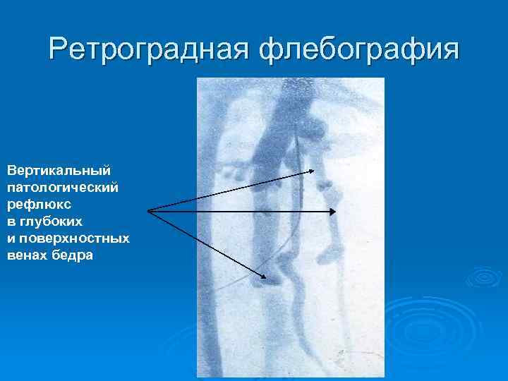 Ретроградная флебография Вертикальный патологический рефлюкс в глубоких и поверхностных венах бедра 