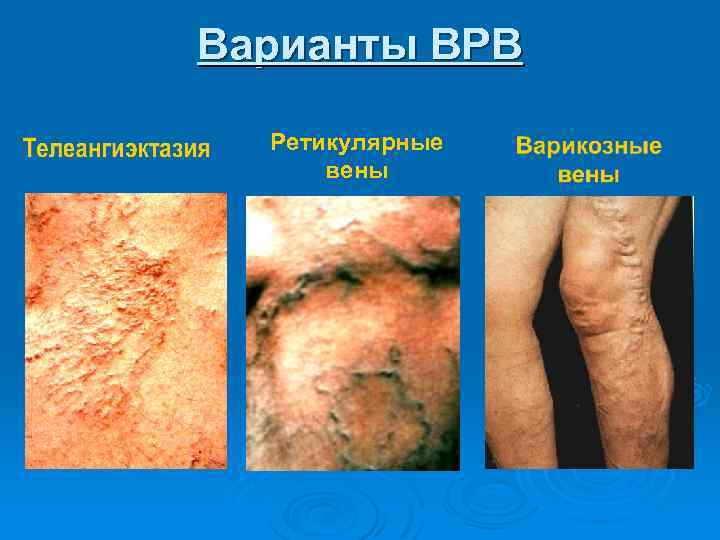 Варианты ВРВ Ретикулярные вены 