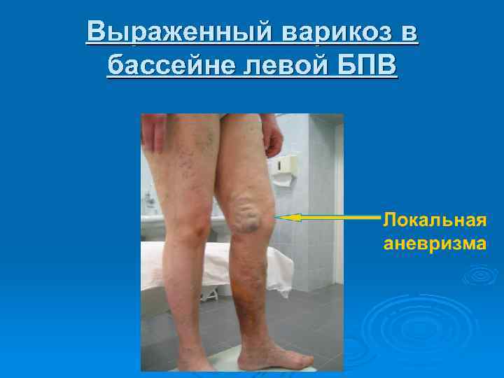 Выраженный варикоз в бассейне левой БПВ 