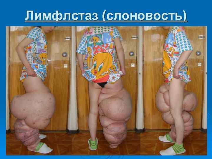 Лимфлстаз (слоновость) 