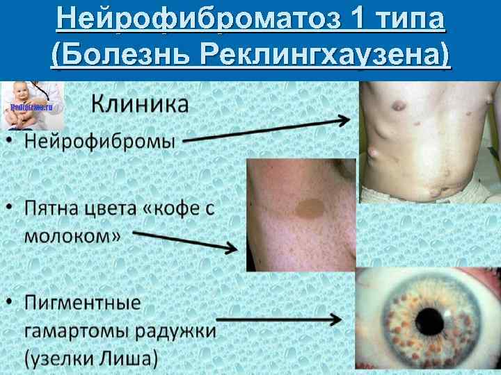 Нейрофиброматоз 1 типа (Болезнь Реклингхаузена) 