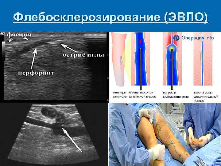 Флебосклерозирование (ЭВЛО) 
