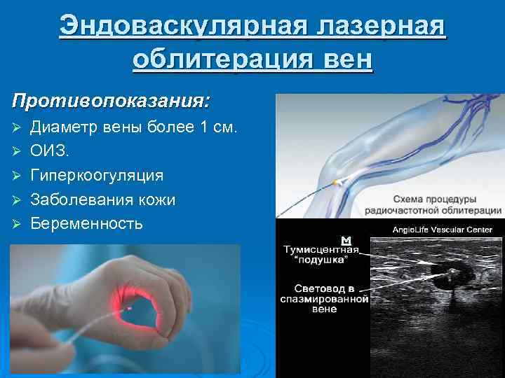 Эндоваскулярная лазерная облитерация вен Противопоказания: Ø Ø Ø Диаметр вены более 1 см. ОИЗ.