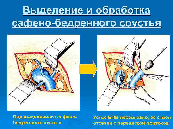Выделение и обработка сафено-бедренного соустья Вид выделенного сафенобедренного соустья Устье БПВ перевязано, ее ствол