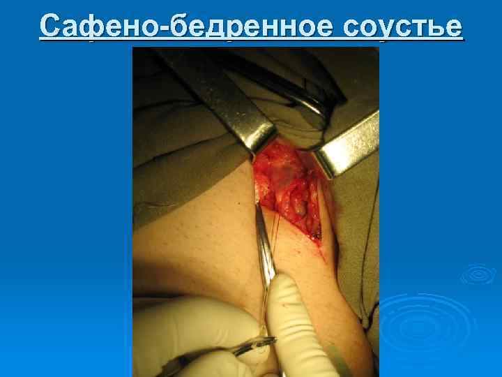 Сафено-бедренное соустье 