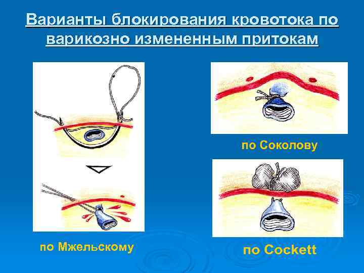 Варианты блокирования кровотока по варикозно измененным притокам по Мжельскому 
