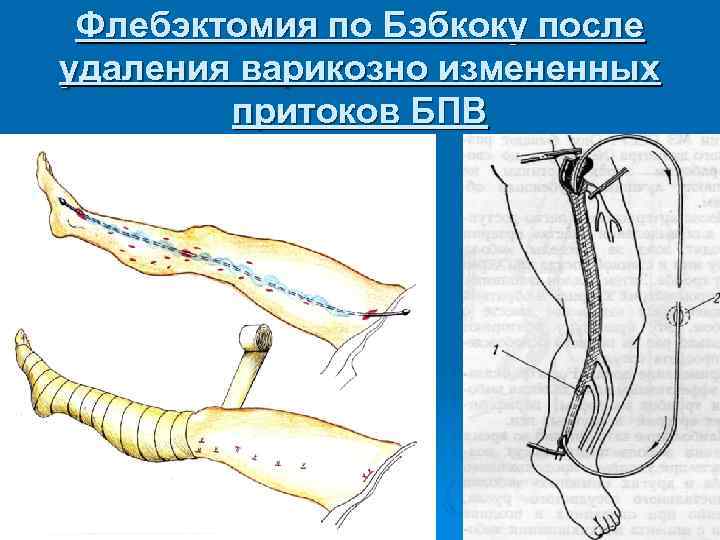 Флебэктомия по Бэбкоку после удаления варикозно измененных притоков БПВ 