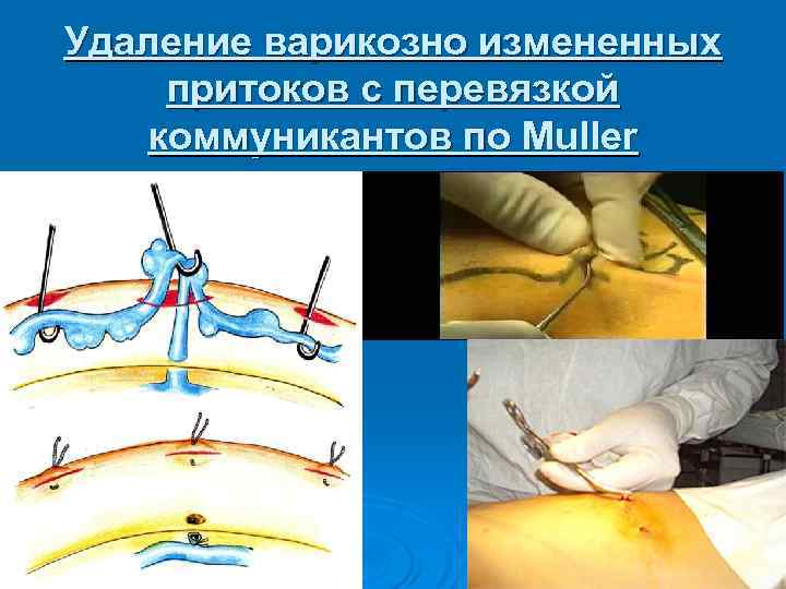 Удаление варикозно измененных притоков с перевязкой коммуникантов по Muller 
