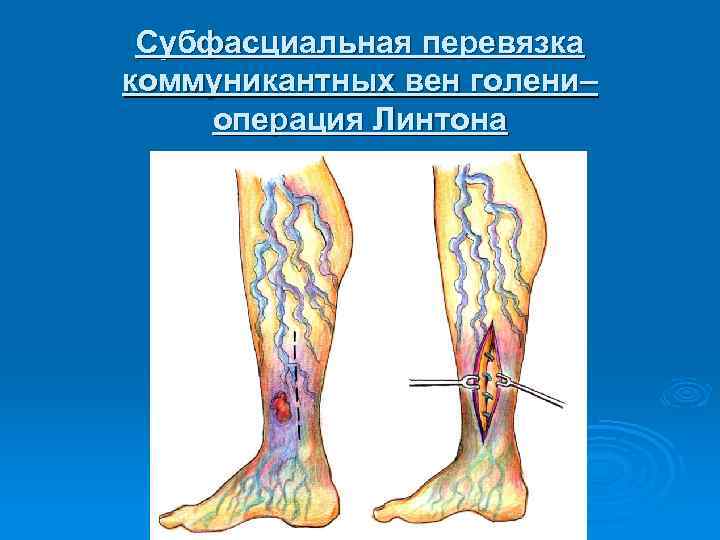 Субфасциальная перевязка коммуникантных вен голени– операция Линтона 