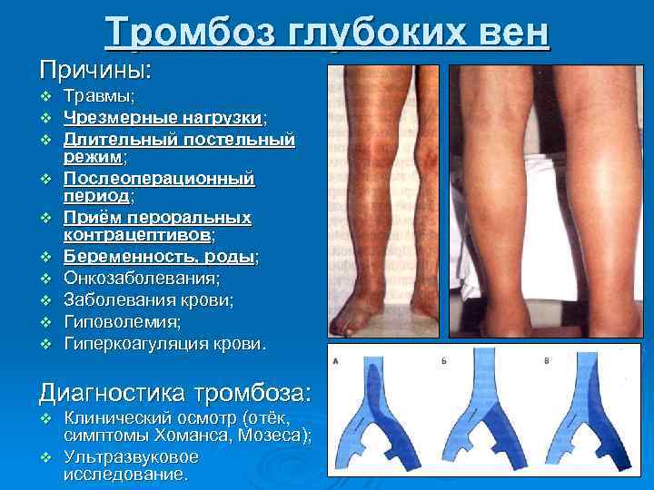 Тромбоз глубоких вен Причины: v v v v v Травмы; Чрезмерные нагрузки; Длительный постельный