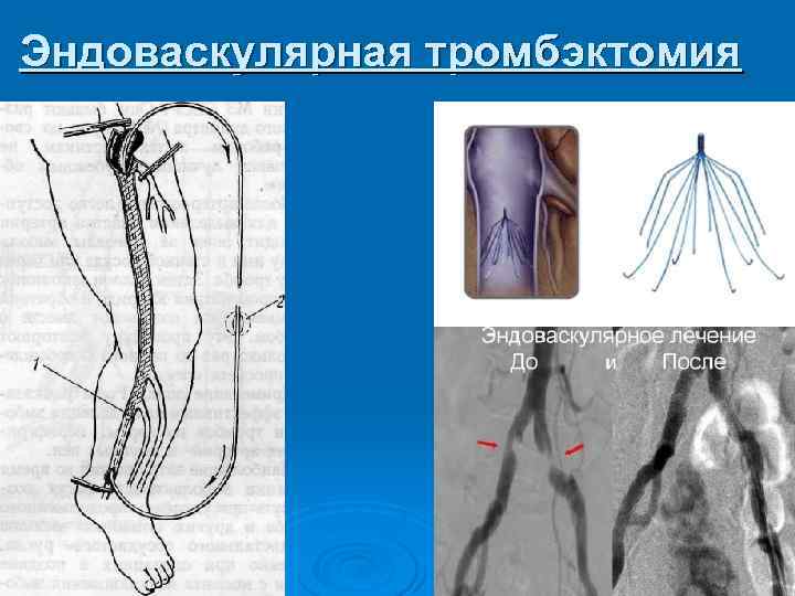 Эндоваскулярная тромбэктомия 