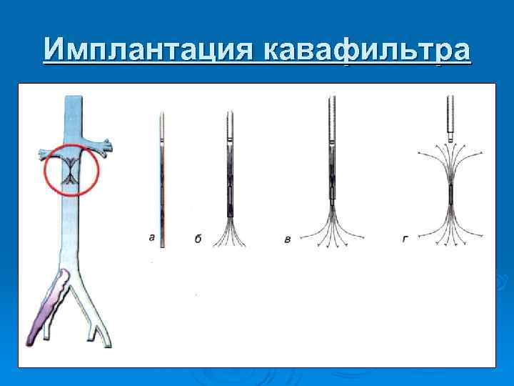 Имплантация кавафильтра 