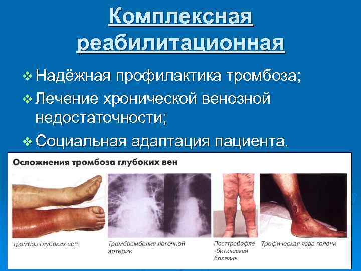 Комплексная реабилитационная v Надёжная профилактика тромбоза; v Лечение хронической венозной недостаточности; v Социальная адаптация