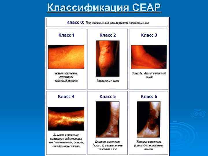 Классификация СЕАР 