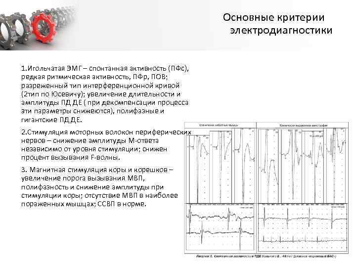 Основные критерии электродиагностики 1. Игольчатая ЭМГ – спонтанная активность (ПФс), редкая ритмическая активность, ПФр,