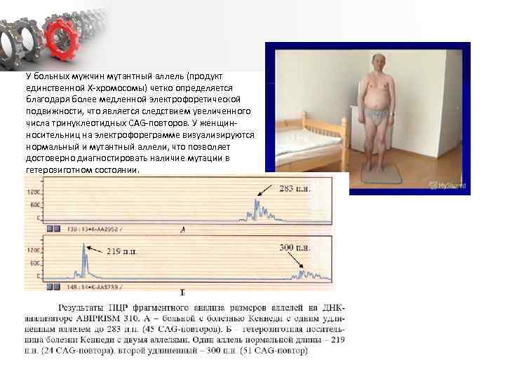 У больных мужчин мутантный аллель (продукт единственной Х хромосомы) четко определяется благодаря более медленной