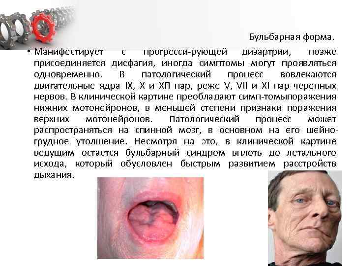 Бульбарная форма. • Манифестирует с прогресси рующей дизартрии, позже присоединяется дисфагия, иногда симптомы могут