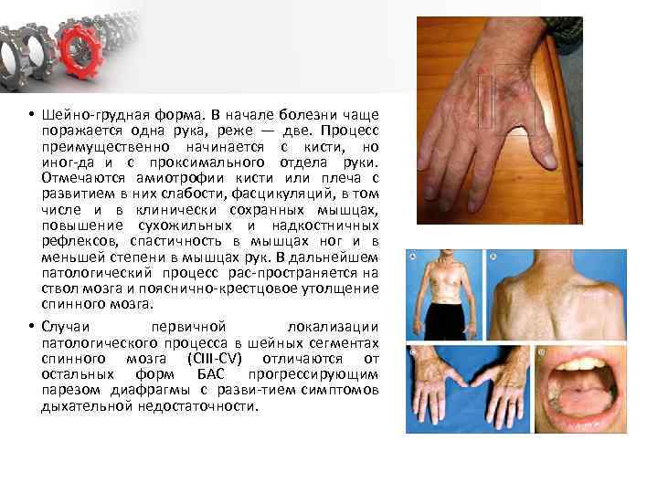  • Шейно грудная форма. В начале болезни чаще поражается одна рука, реже —