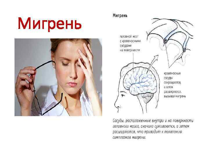 Мигрень 