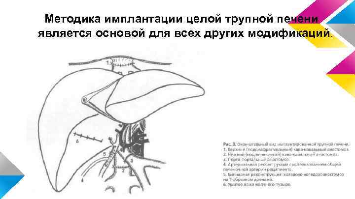 Методика имплантации целой трупной печени является основой для всех других модификаций. 