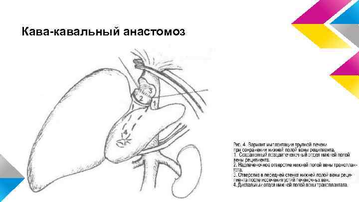 Кава-кавальный анастомоз 