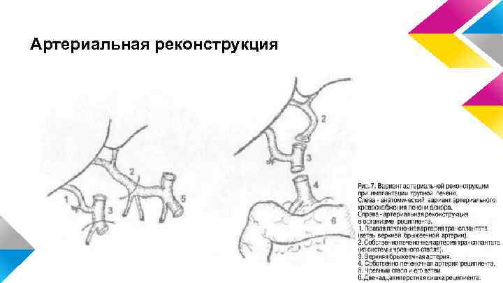 Артериальная реконструкция 