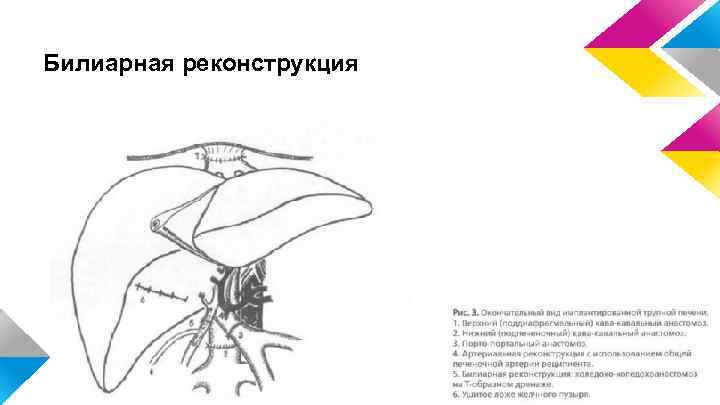 Билиарная реконструкция 