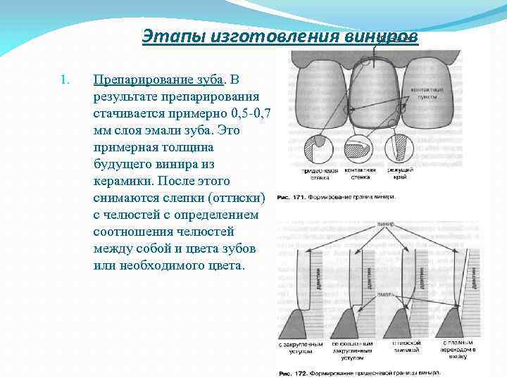 Этапы изготовления виниров 1. Препарирование зуба. В результате препарирования стачивается примерно 0, 5 -0,