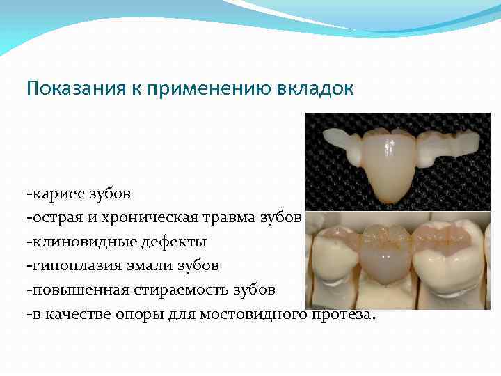 Показания к применению вкладок -кариес зубов -острая и хроническая травма зубов -клиновидные дефекты -гипоплазия