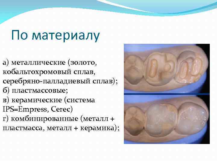 По материалу а) металлические (золото, кобальтохромовый сплав, серебряно-палладиевый сплав); б) пластмассовые; в) керамические (система
