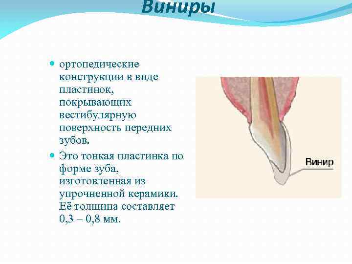 Виниры ортопедические конструкции в виде пластинок, покрывающих вестибулярную поверхность передних зубов. Это тонкая пластинка