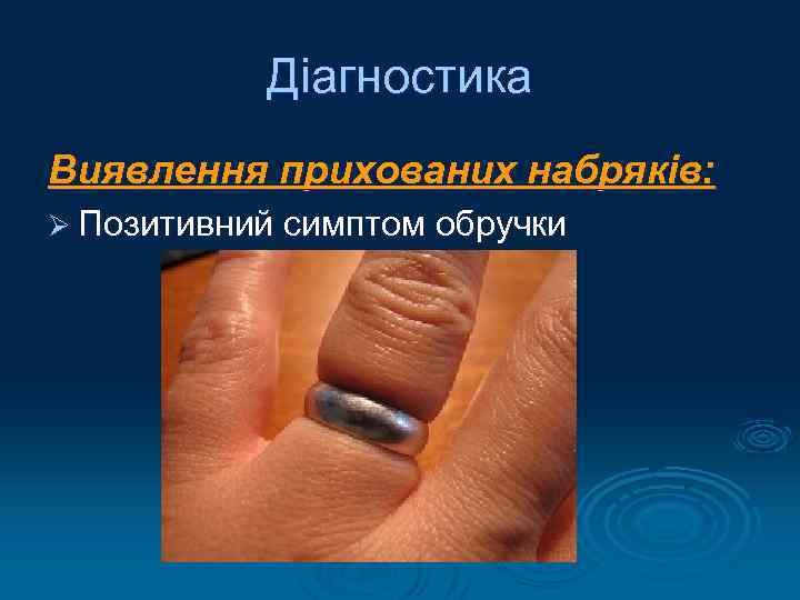 Діагностика Виявлення прихованих набряків: Ø Позитивний симптом обручки 