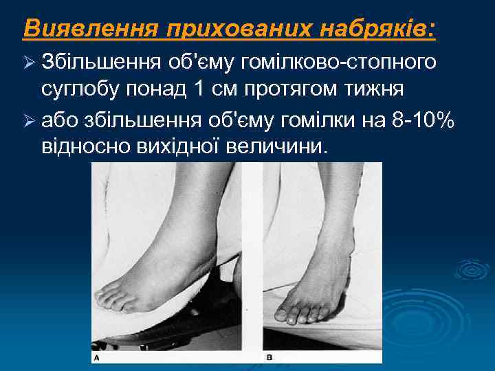 Виявлення прихованих набряків: Ø Збільшення об'єму гомілково-стопного суглобу понад 1 см протягом тижня Ø