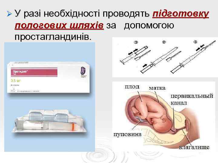 Ø У разі необхідності проводять підготовку пологових шляхів за допомогою простагландинів. 