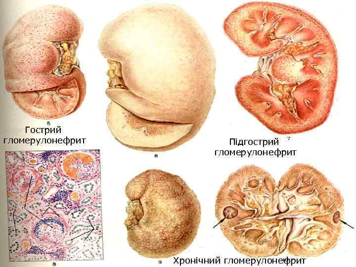 Гострий гломерулонефрит Підгострий гломерулонефрит Хронічний гломерулонефрит 