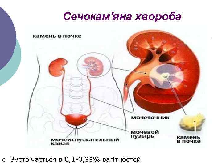 Сечокам'яна хвороба ¡ Зустрічається в 0, 1 -0, 35% вагітностей. 