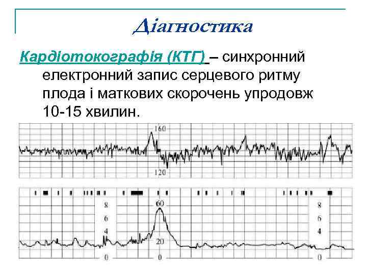 Діагностика Кардіотокографія (КТГ) – синхронний електронний запис серцевого ритму плода і маткових скорочень упродовж