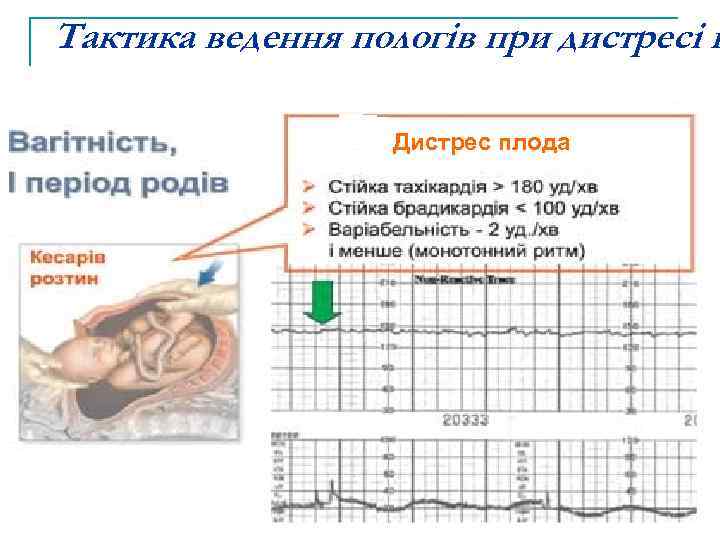 Тактика ведення пологів при дистресі п Дистрес плода 