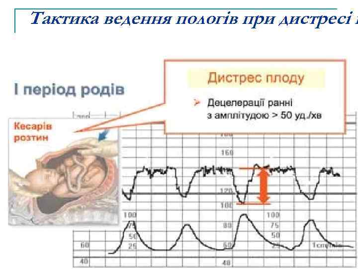 Тактика ведення пологів при дистресі п 