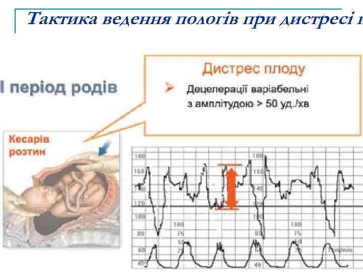 Тактика ведення пологів при дистресі п 