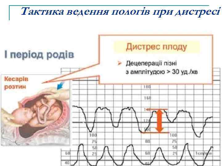 Тактика ведення пологів при дистресі 