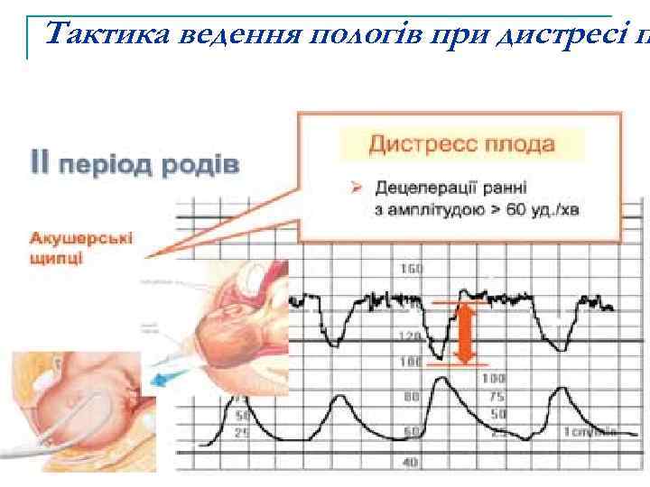 Тактика ведення пологів при дистресі п 