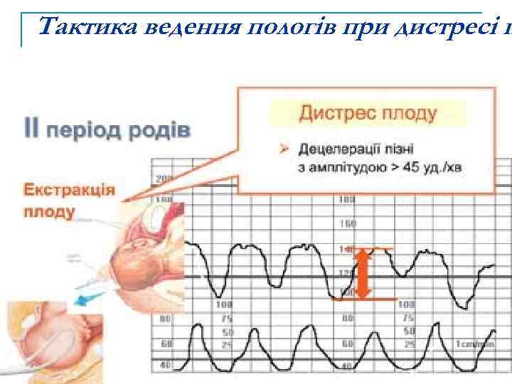 Тактика ведення пологів при дистресі п 