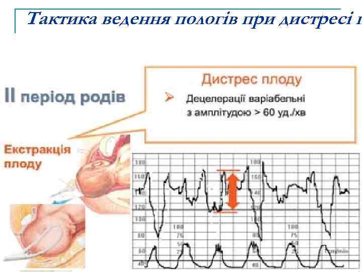 Тактика ведення пологів при дистресі п 