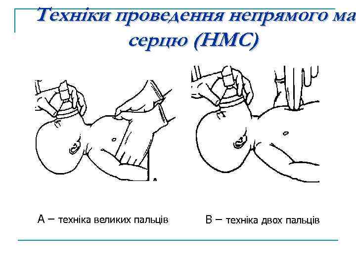 Техніки проведення непрямого мас серцю (НМС) A A – техніка великих пальців B B