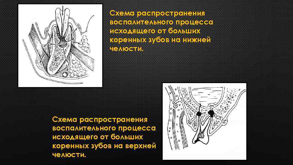 Схема распространения воспалительного процесса исходящего от больших коренных зубов на нижней челюсти. Схема распространения