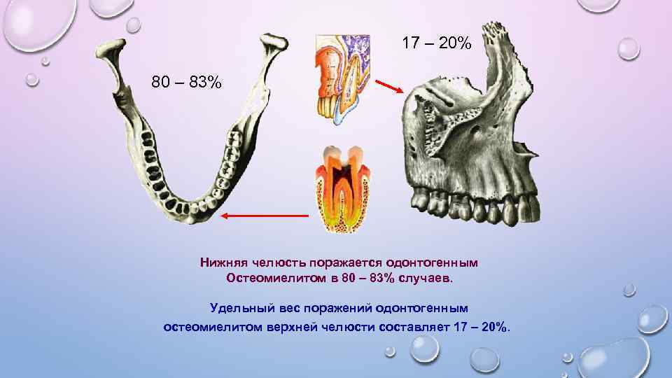 Клиническая картина острого одонтогенного остеомиелита челюсти заключается