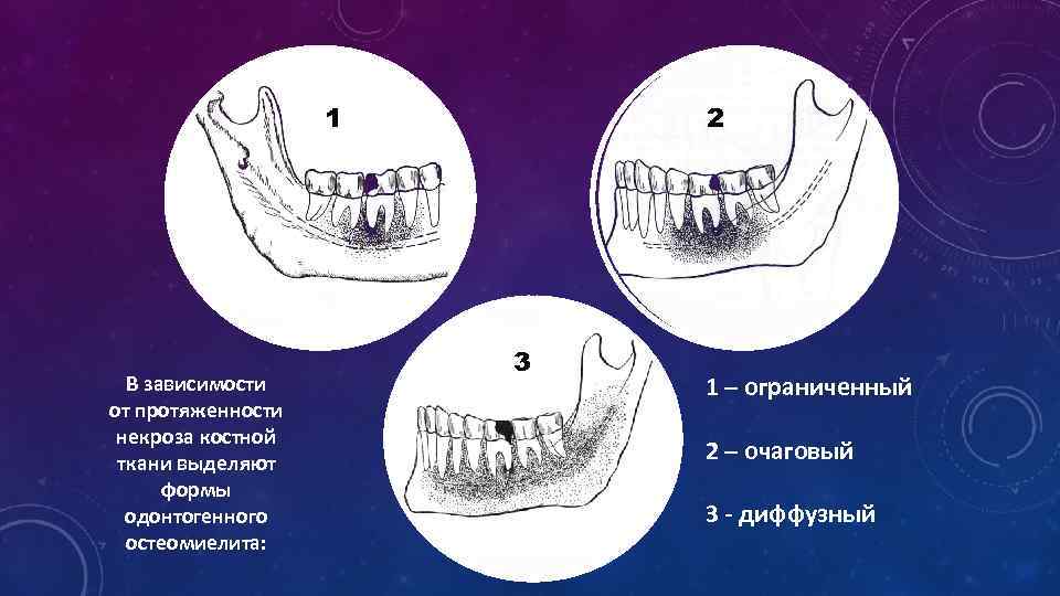 1 В зависимости от протяженности некроза костной ткани выделяют формы одонтогенного остеомиелита: 2 3
