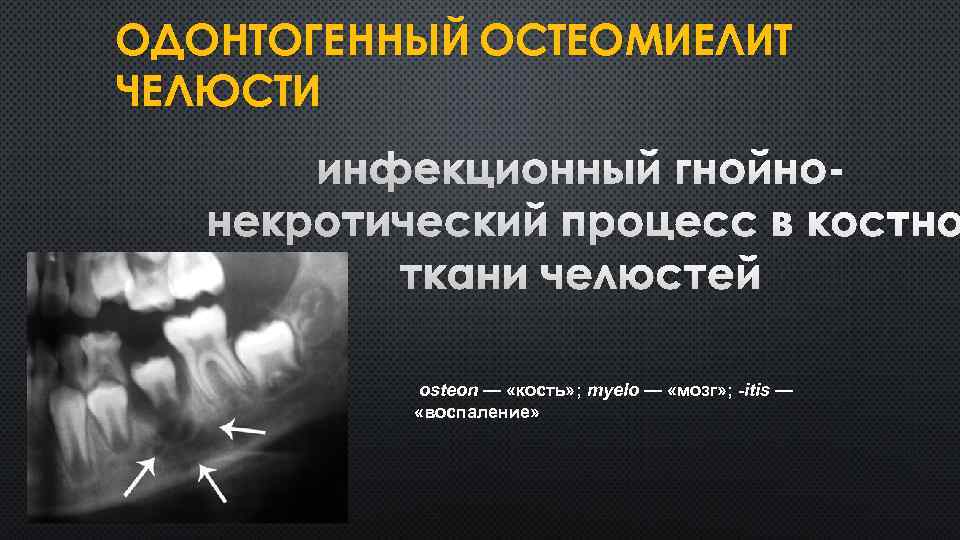 ОДОНТОГЕННЫЙ ОСТЕОМИЕЛИТ ЧЕЛЮСТИ ИНФЕКЦИОННЫЙ ГНОЙНОНЕКРОТИЧЕСКИЙ ПРОЦЕСС В КОСТНОЙ ТКАНИ ЧЕЛЮСТЕЙ osteon — «кость» ;